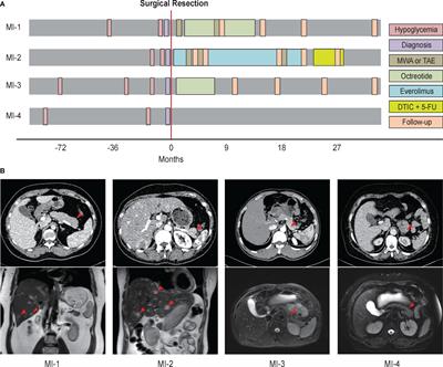 Metastatic insulinoma: exploration from clinicopathological signatures and genetic characteristics